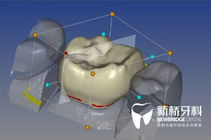 种植牙3D打印 几天种好牙将成可能